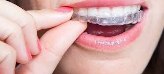 Transform Your Smile with Expert Veneers in Aurora